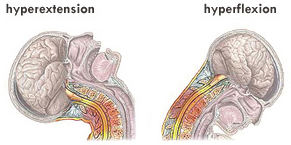 hyperextension-hyperflexion