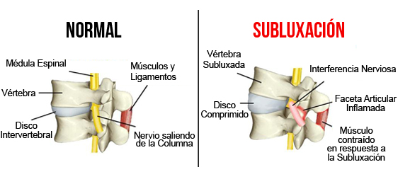 subluxacion vertebral