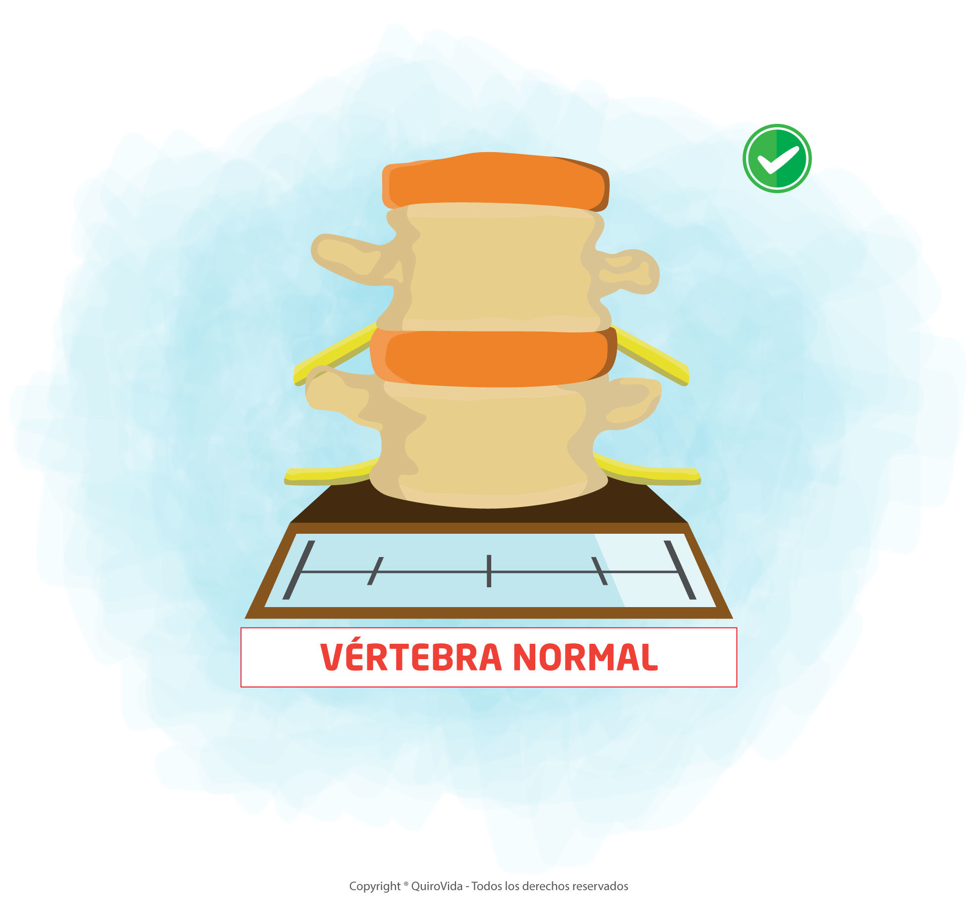 Síntomas y causas de la Artrosis (Degeneración) QuiroVida Centro